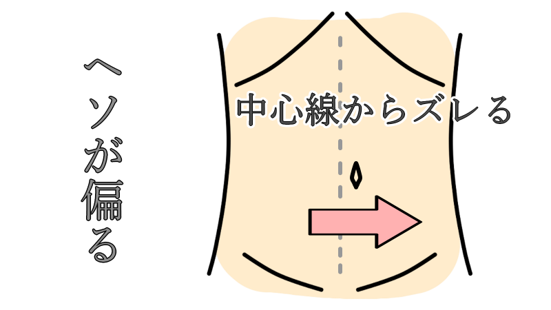 bellybutton_sift